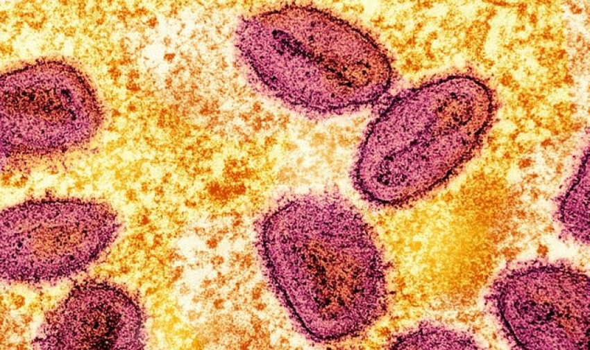 Mpox: New case of Clade 1b strain detected in UK